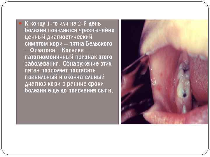  К концу 1 -го или на 2 -й день болезни появляется чрезвычайно ценный
