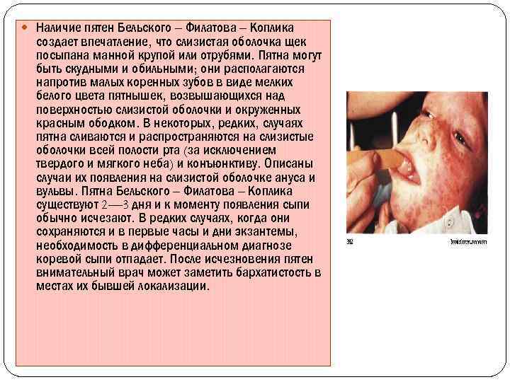  Наличие пятен Бельского – Филатова – Коплика создает впечатление, что слизистая оболочка щек