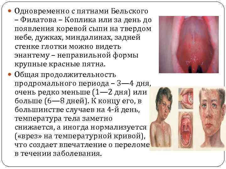  Одновременно с пятнами Бельского – Филатова – Коплика или за день до появления