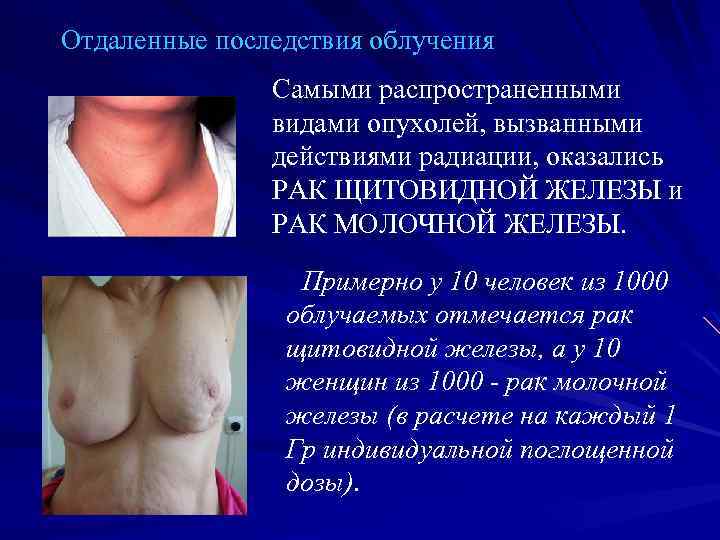 Отдаленные последствия облучения Самыми распространенными видами опухолей, вызванными действиями радиации, оказались РАК ЩИТОВИДНОЙ ЖЕЛЕЗЫ