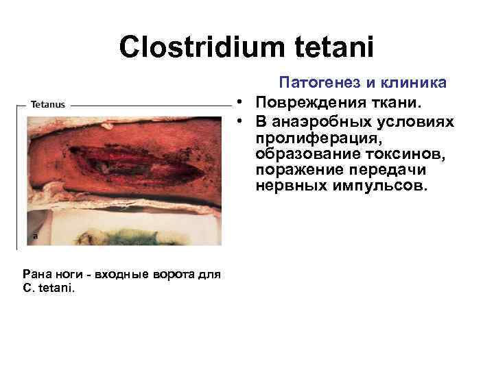 Clostridium tetani Патогенез и клиника • Повреждения ткани. • В анаэробных условиях пролиферация, образование