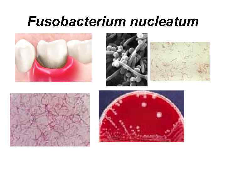 Fusobacterium nucleatum 