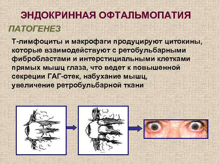 Эндокринная офтальмопатия