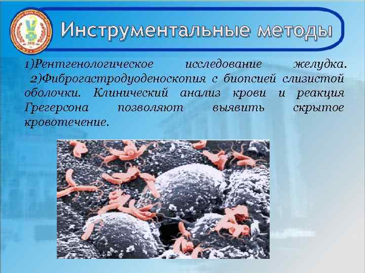 Инструментальные методы 1)Рентгенологическое исследование желудка. 2)Фиброгастродуоденоскопия с биопсией слизистой оболочки. Клинический анализ крови и