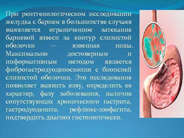 При рентгенологическом исследовании желудка с барием в большинстве случаев выявляется ограниченное затекание бариевой взвеси