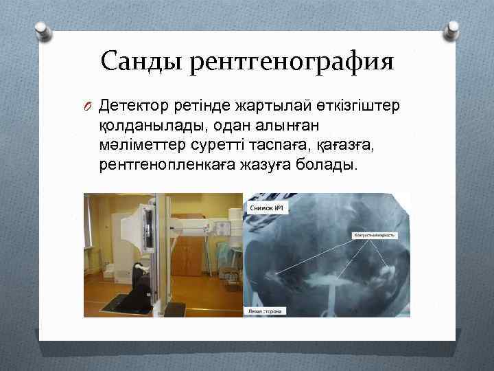 Санды рентгенография O Детектор ретінде жартылай өткізгіштер қолданылады, одан алынған мәліметтер суретті таспаға, қағазға,