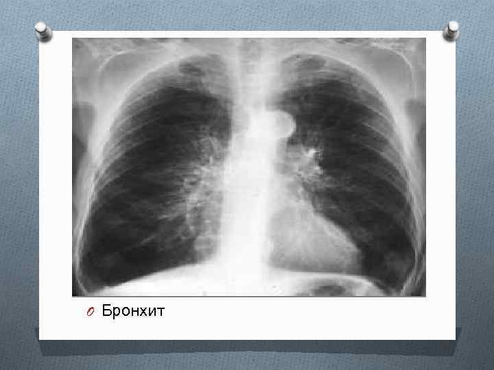 Бронхит на рентгене легких