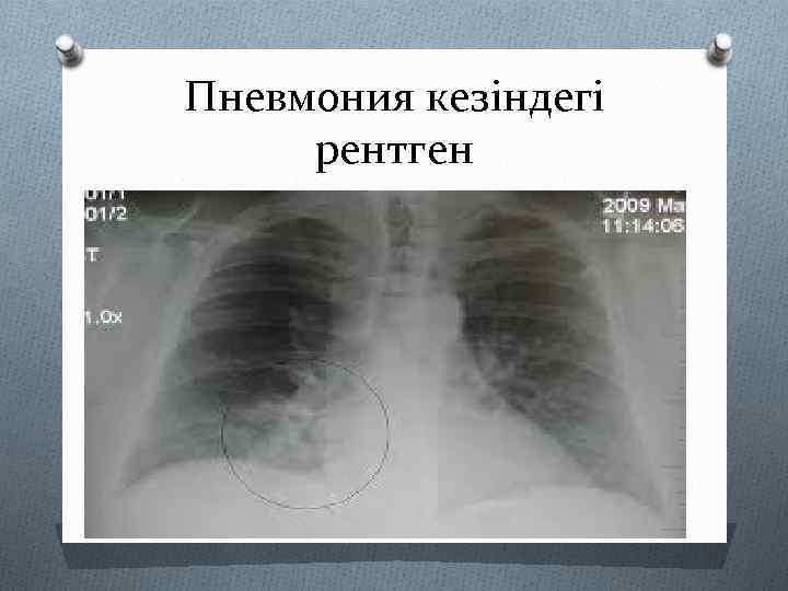 Пневмония кезіндегі рентген 