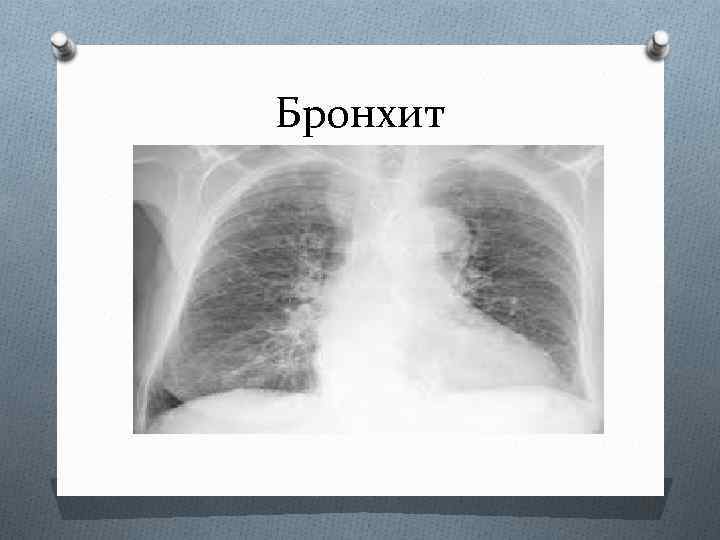 Бронхит на рентгене легких. Хронический бронхит рентген. Бронхит и пневмония на рентгене. Обструктивный бронхит рентген. Острый бронхит снимок рентген.