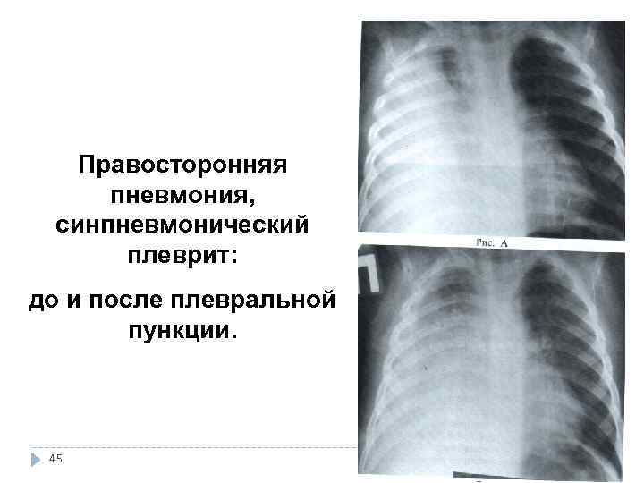 Правосторонняя пневмония у ребенка. Синпневмонический плеврит. Левосторонняя полисегментарная пневмония рентген. Метапневмонический плеврит клиника. Метапневмонический плеврит.