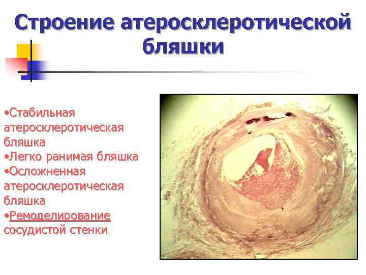 Строение атеросклеротической бляшки • Стабильная атеросклеротическая бляшка • Легко ранимая бляшка • Осложненная атеросклеротическая