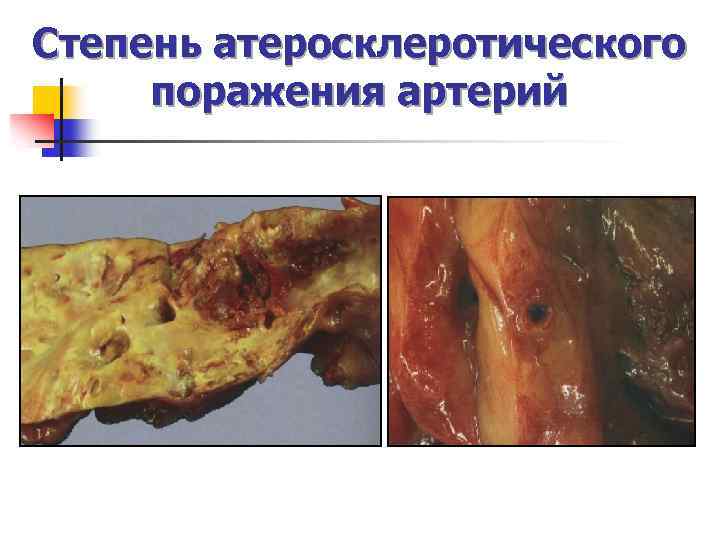 Степень атеросклеротического поражения артерий 