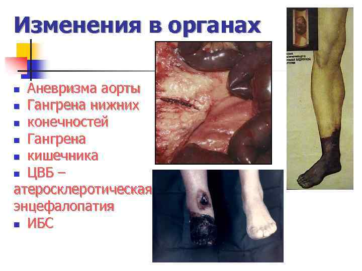 Изменения в органах Аневризма аорты n Гангрена нижних n конечностей n Гангрена n кишечника