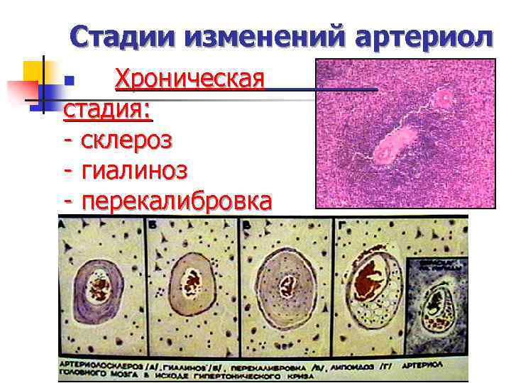 Стадии изменений. Гиалиноз микроскопические изменения. Стадии сосудистого гиалиноза. Стадии изменения в артериолах.