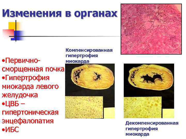Изменения в органах • Первичносморщенная почка • Гипертрофия миокарда левого желудочка • ЦВБ –