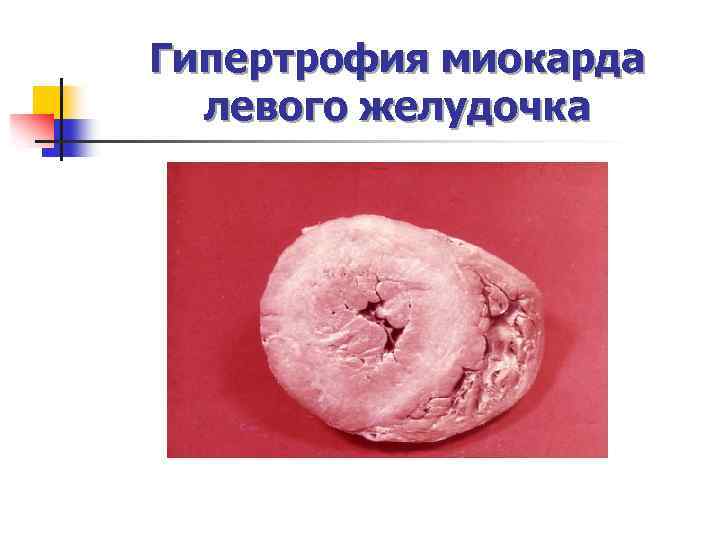 Гипертрофия миокарда левого желудочка 