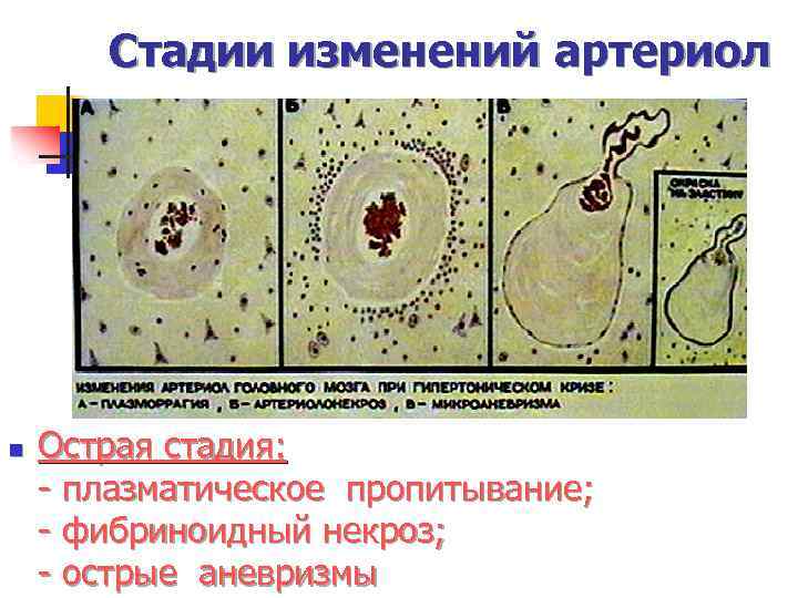 Стадии изменений артериол n Острая стадия: - плазматическое пропитывание; - фибриноидный некроз; - острые