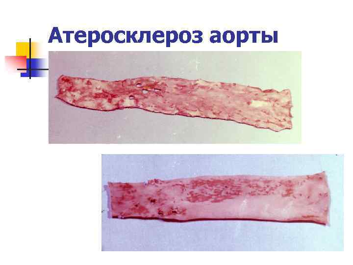 Атеросклероз аорты 