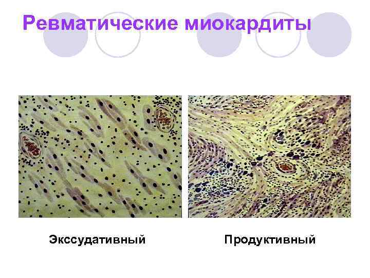 Экссудативная энтеропатия презентация