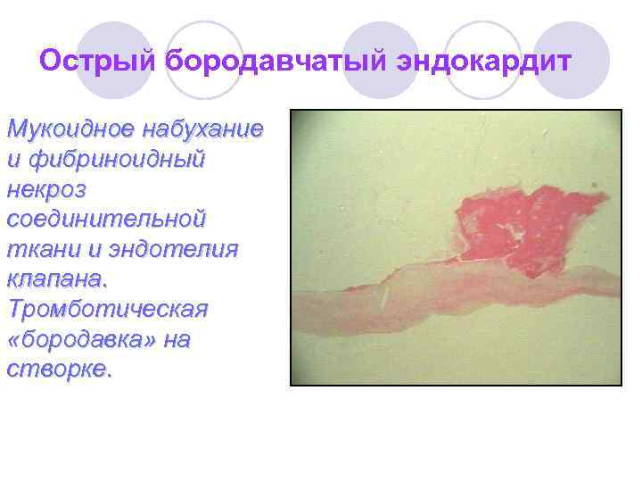 Острый бородавчатый эндокардит Мукоидное набухание и фибриноидный некроз соединительной ткани и эндотелия клапана. Тромботическая