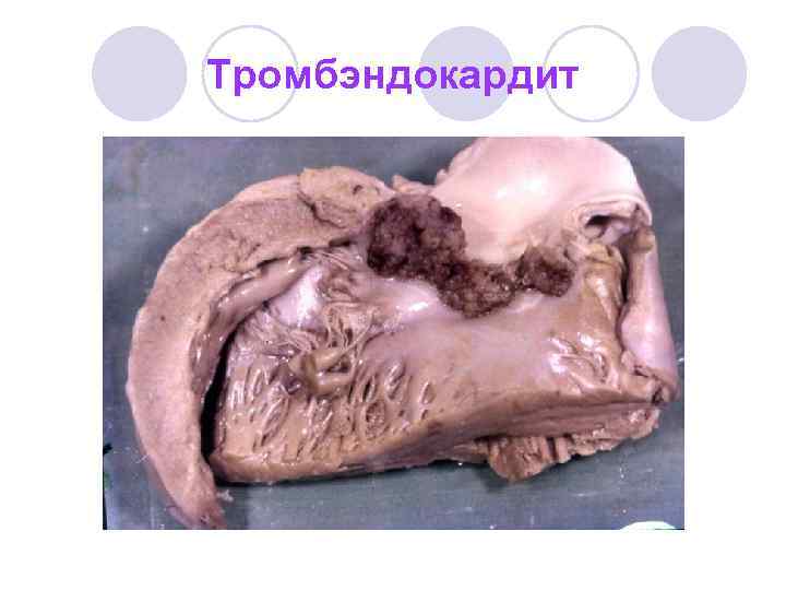 Тромбэндокардит 