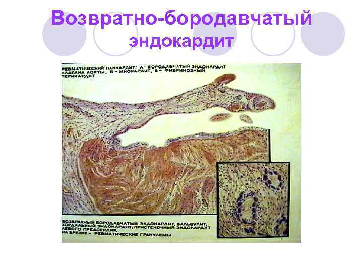 Возвратно-бородавчатый эндокардит 