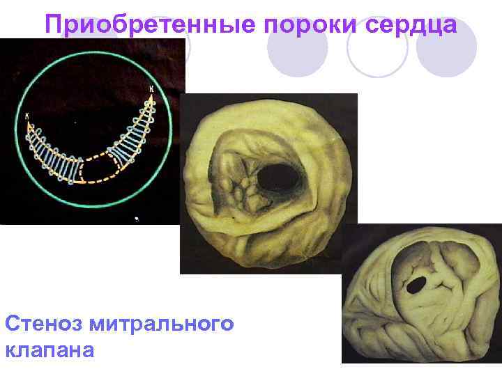 Приобретенные пороки сердца Стеноз митрального клапана 