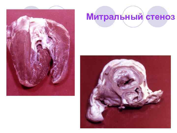 Митральный стеноз 
