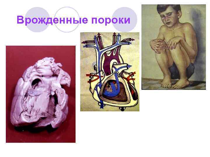 Врожденные пороки 