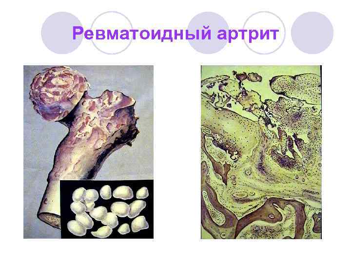 Диффузные заболевания соединительной ткани презентация