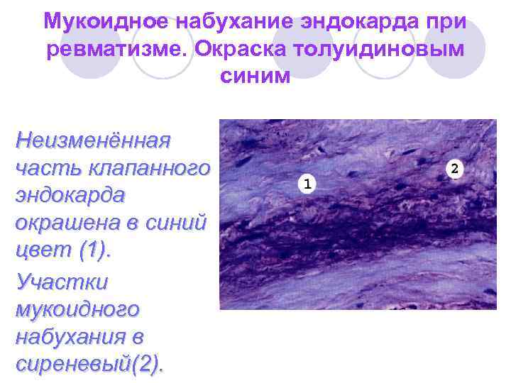 Ревматические болезни митрального клапана