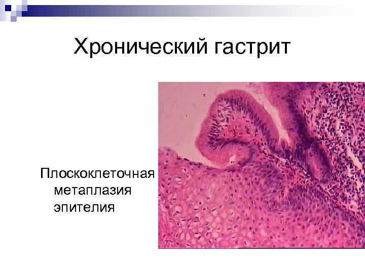 Хронический гастрит Плоскоклеточная метаплазия эпителия 