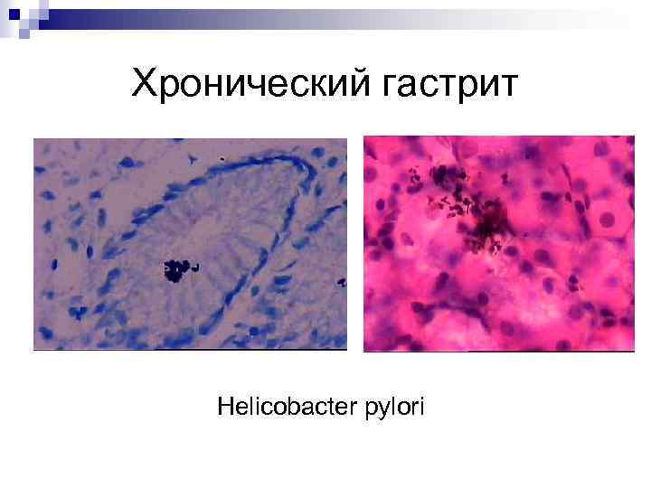 Хронический гастрит Helicobacter pylori 