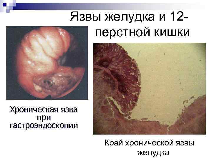 Язвы желудка и 12 перстной кишки Хроническая язва при гастроэндоскопии Край хронической язвы желудка