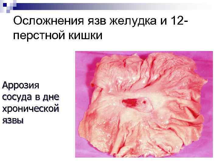 Осложнения язв желудка и 12 перстной кишки Аррозия сосуда в дне хронической язвы 