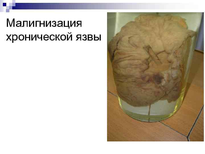 Малигнизация хронической язвы 