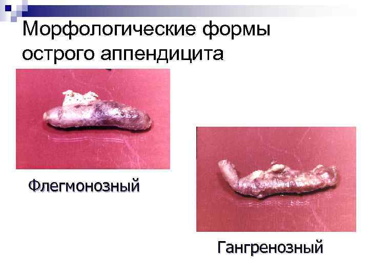 Морфологические формы острого аппендицита Флегмонозный Гангренозный 