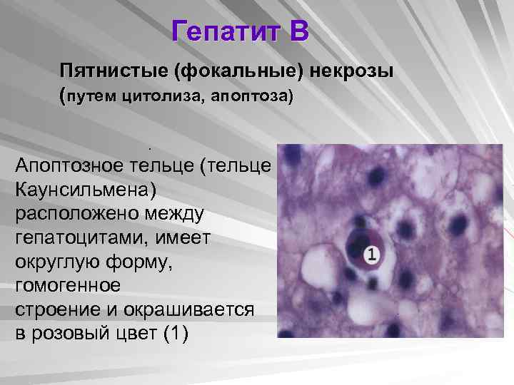 Гепатит В Пятнистые (фокальные) некрозы (путем цитолиза, апоптоза). Апоптозное тельце (тельце Каунсильмена) расположено между