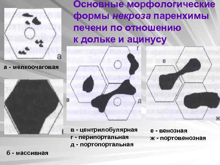 Основные морфологические формы некроза паренхимы печени по отношению к дольке и ацинусу а -