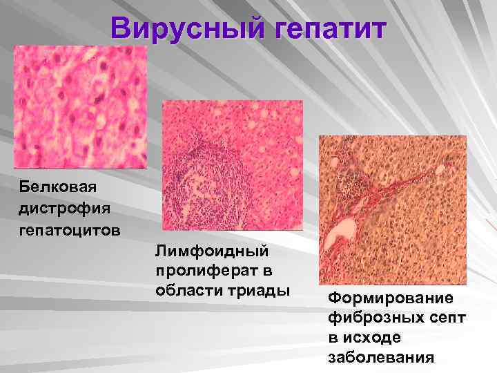 Вирусный гепатит Белковая дистрофия гепатоцитов Лимфоидный пролиферат в области триады Формирование фиброзных септ в