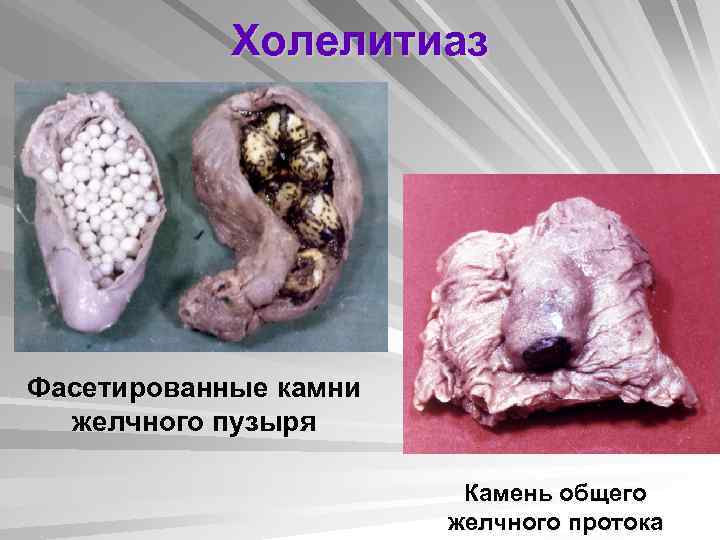 Холелитиаз Фасетированные камни желчного пузыря Камень общего желчного протока 