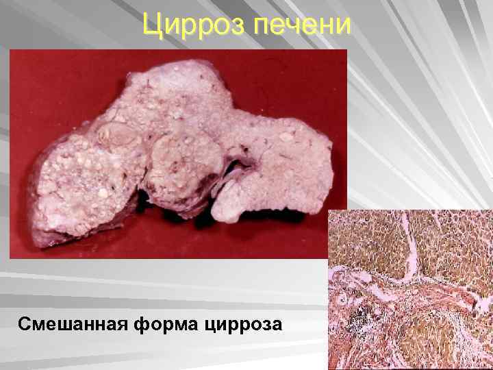 Цирроз печени Смешанная форма цирроза 