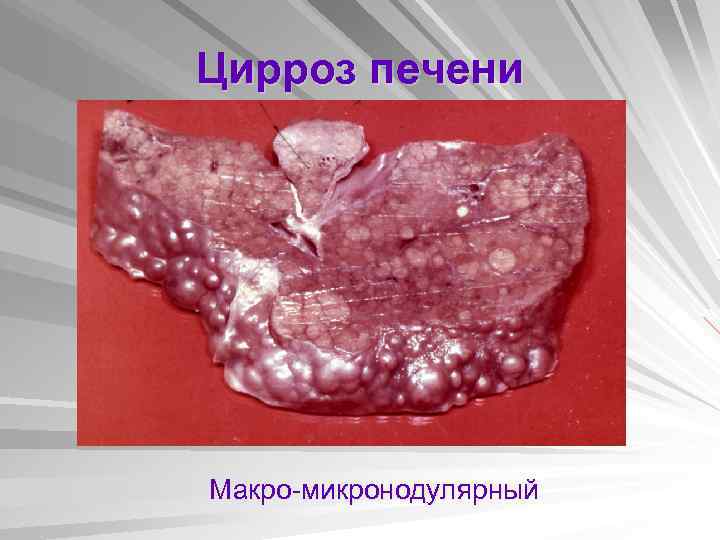 Цирроз печени Макро-микронодулярный 