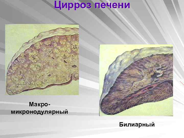 Вторичный билиарный цирроз печени