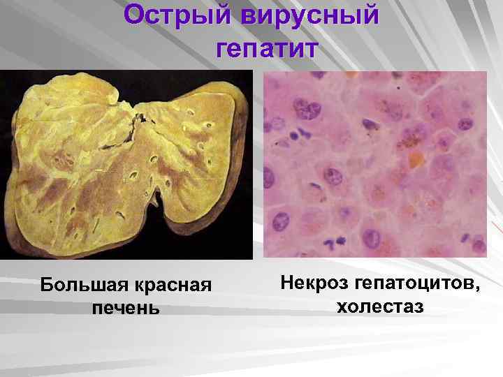 Острый вирусный гепатит Большая красная печень Некроз гепатоцитов, холестаз 