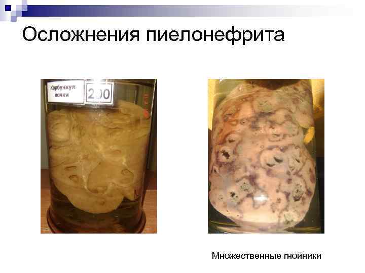 Осложнения пиелонефрита Множественные гнойники 