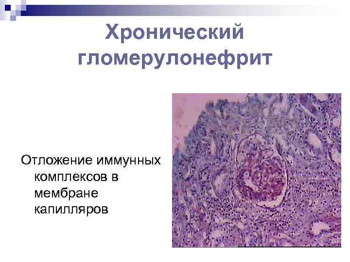 Гломерулонефрит казакша презентация