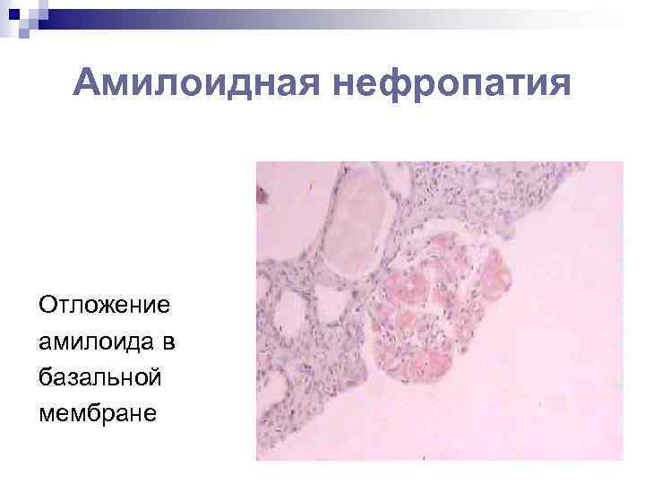 Амилоидная нефропатия Отложение амилоида в базальной мембране 