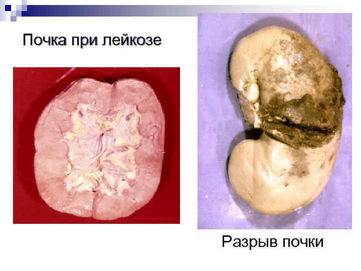 Почка при лейкозе Разрыв почки 