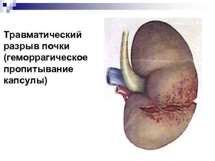 Травматический разрыв почки (геморрагическое пропитывание капсулы) 